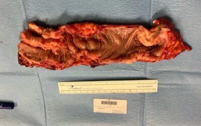 Participation in the Surgical Management of Endometriosis in Women