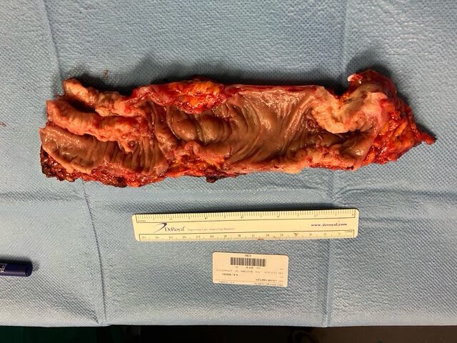 Participation in the Surgical Management of Endometriosis in Women