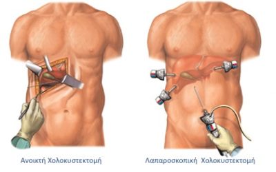 Laparoscopic Cholecystectomy