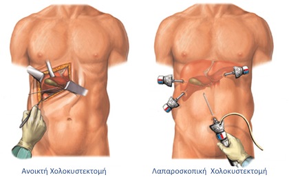 Laparoscopic Cholecystectomy