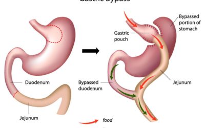 Robotic Gastric Bypass