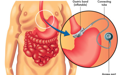 Laparoscopic Placement of Gastric Band