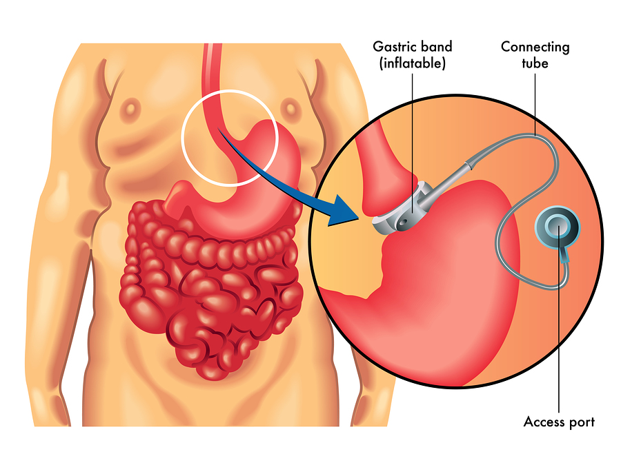 Laparoscopic Placement of Gastric Band