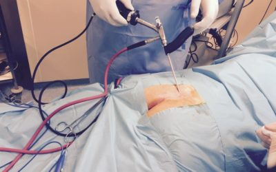 Endoscopic Pilonidal Sinus Treatment (EPSiT)
