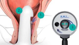 Hemorrhoidectomy Hal-Rar