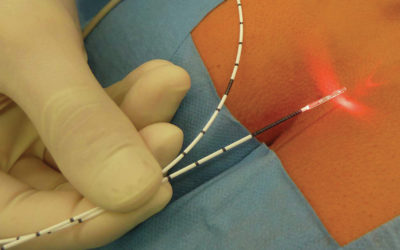 Laser Pilonidal Cyst Treatment