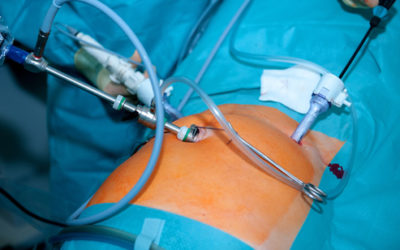 Laparoscopic Colectomies