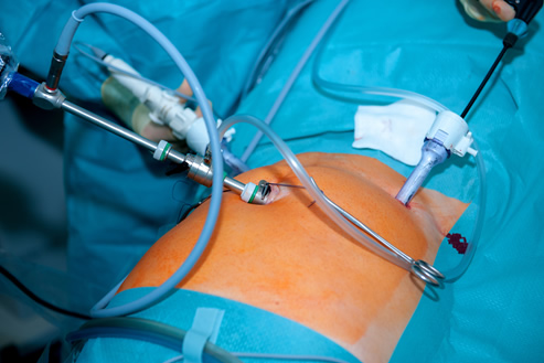 Laparoscopic Colectomies