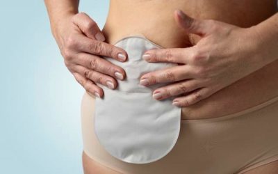 Colostomy Reversal / Closure