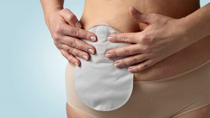 Colostomies