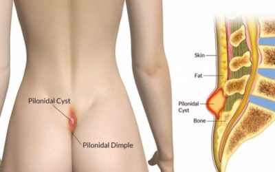 Pilonidal Cyst – Open Method