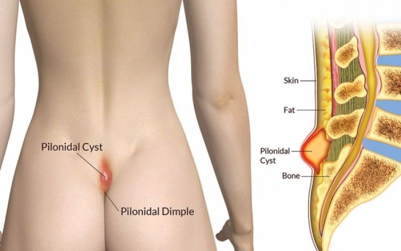 Pilonidal Cyst – Open Method