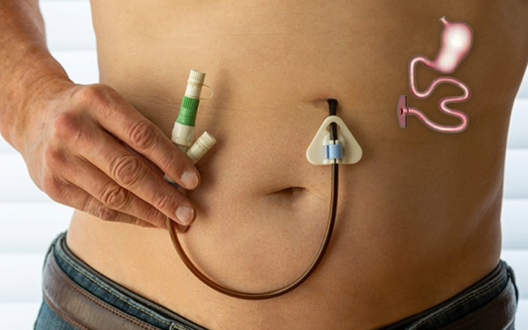 Jejunostomy