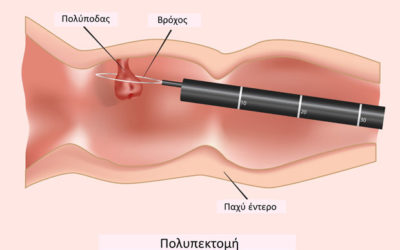Λαπαροσκοπική Αφαίρεση Πολυπόδων Ορθού