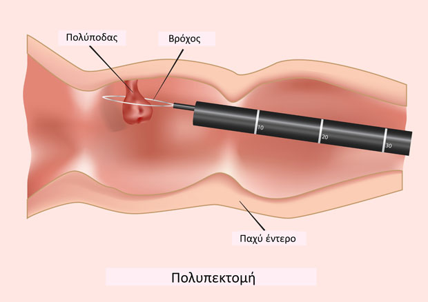 Λαπαροσκοπική Αφαίρεση Πολυπόδων Ορθού
