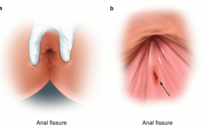 Anal Fissure