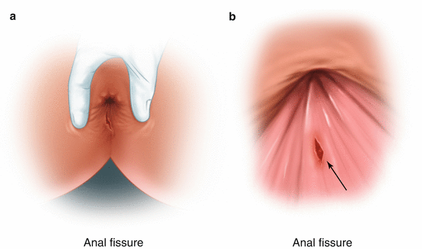 Anal Fissure
