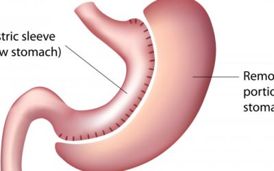Robotic Sleeve Gastrectomy