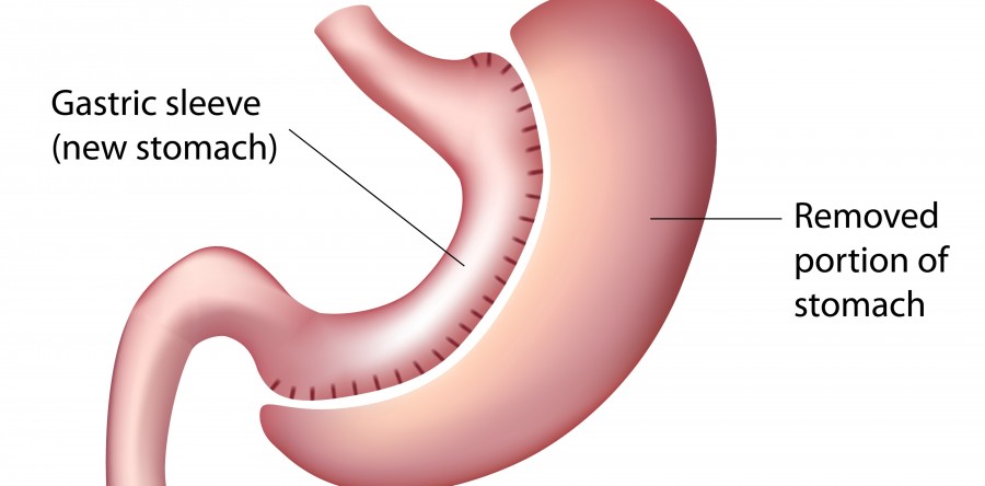Laparoscopic Sleeve Gastrectomy