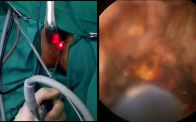Video-Assisted Anal Fistula Treatment (VAFT)
