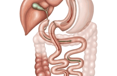 Biliopancreatic Diversion (BPD)