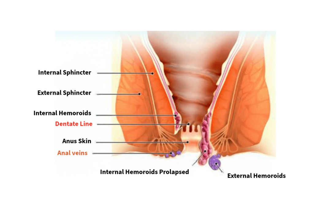 Hemorrhoidectomy
