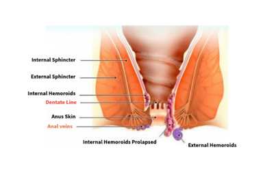 Hemorrhoidectomy LOGO