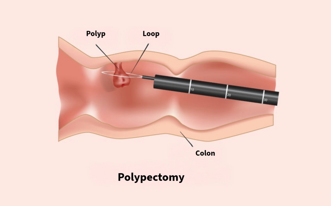 Laparoscopic Removal of Rectal Polyps