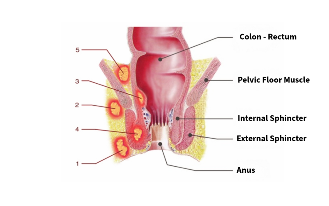 Perianal Abscesses