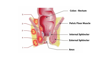 Perianal Abscesses