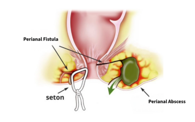 Perianal Fistulas