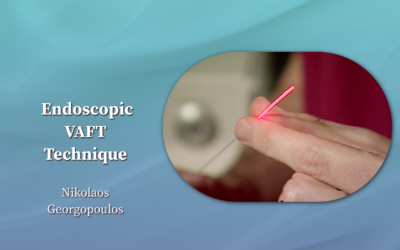Perianal Fistulas – Endoscopic VAFT Technique